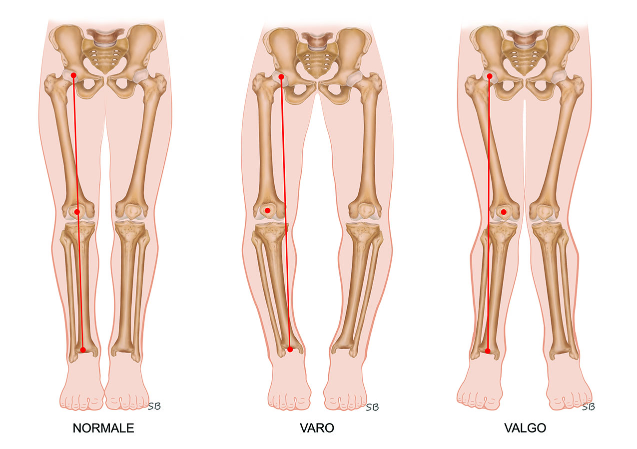 Osteotomia del ginocchio