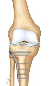 osteotomia