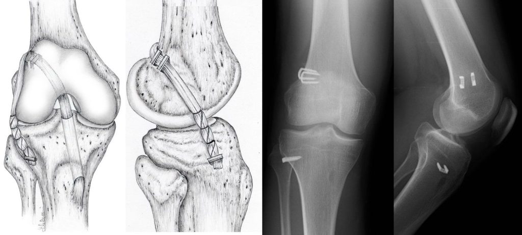 Tecnica chirurgica OVER-THE-TOP + plastica esterna: schema chirurgico e controllo radiografico post-operatorio