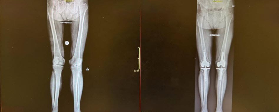 ginocchia difficili