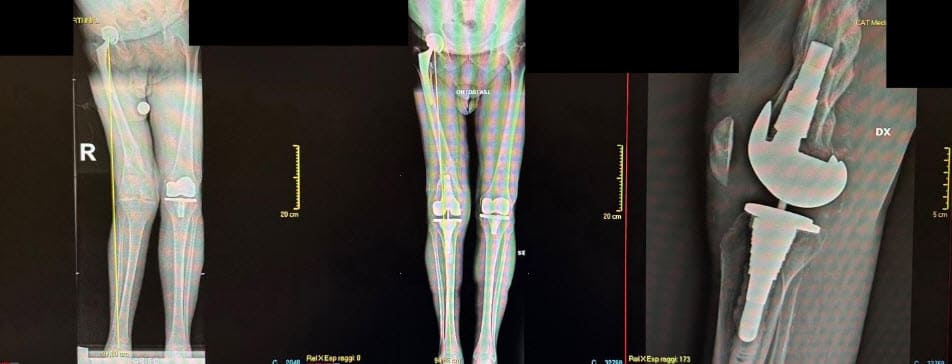ginocchia difficili