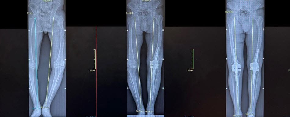 ginocchia difficili