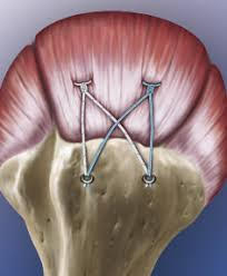 Fig. 6 Controllo radiografico postoperatorio dopo stabilizzazione AC mediante tecnica mininvasiva.