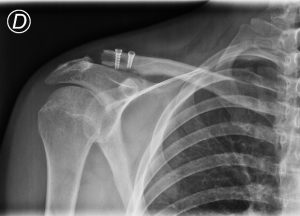 Riparazione di lussazione acromion-claveare