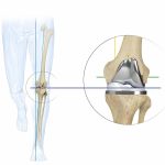 Protesi di Ginocchio a Medial Pivot con Allineamento Cinematico