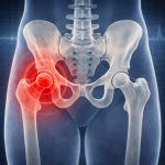 Coxalgia: cos’è, sintomi, cause e trattamenti per il dolore all’anca