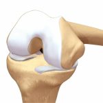 Protesi di ginocchio tempi di recupero anziani: guida completa